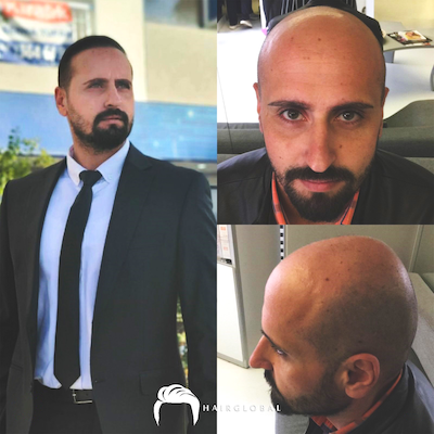 FUE — HairGlobal