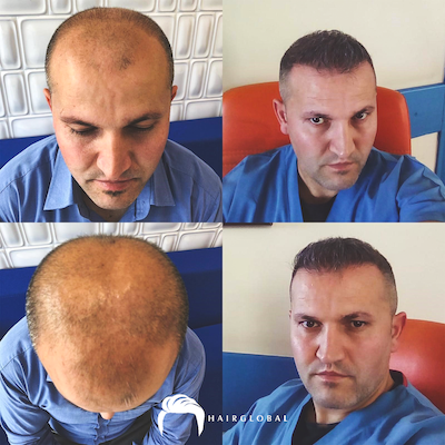 FUE — HairGlobal