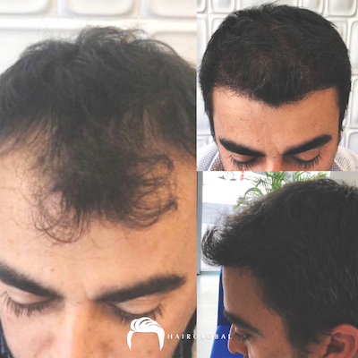FUE — HairGlobal