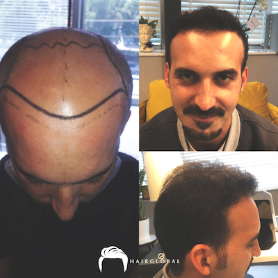 FUE — HairGlobal