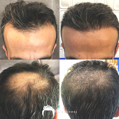 FUE — HairGlobal