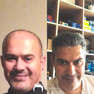 FUE — HairGlobal