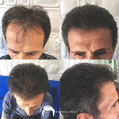 FUE — HairGlobal