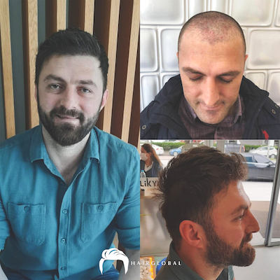FUE — HairGlobal