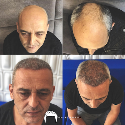FUE — HairGlobal
