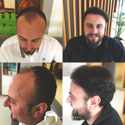 FUE — HairGlobal
