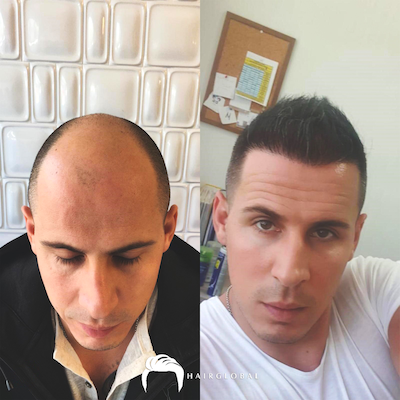 FUE — HairGlobal