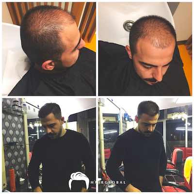FUE — HairGlobal