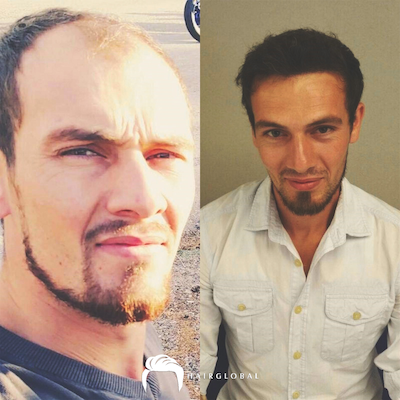FUE — HairGlobal