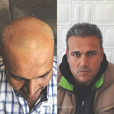 FUE — HairGlobal