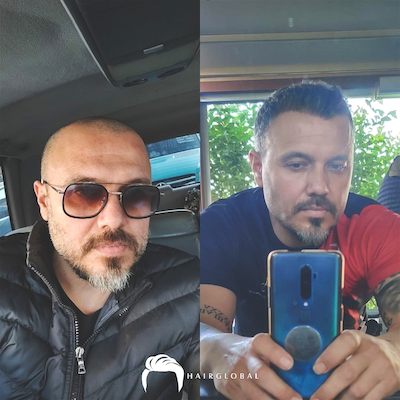 FUE — HairGlobal