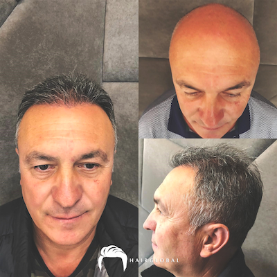 FUE — HairGlobal