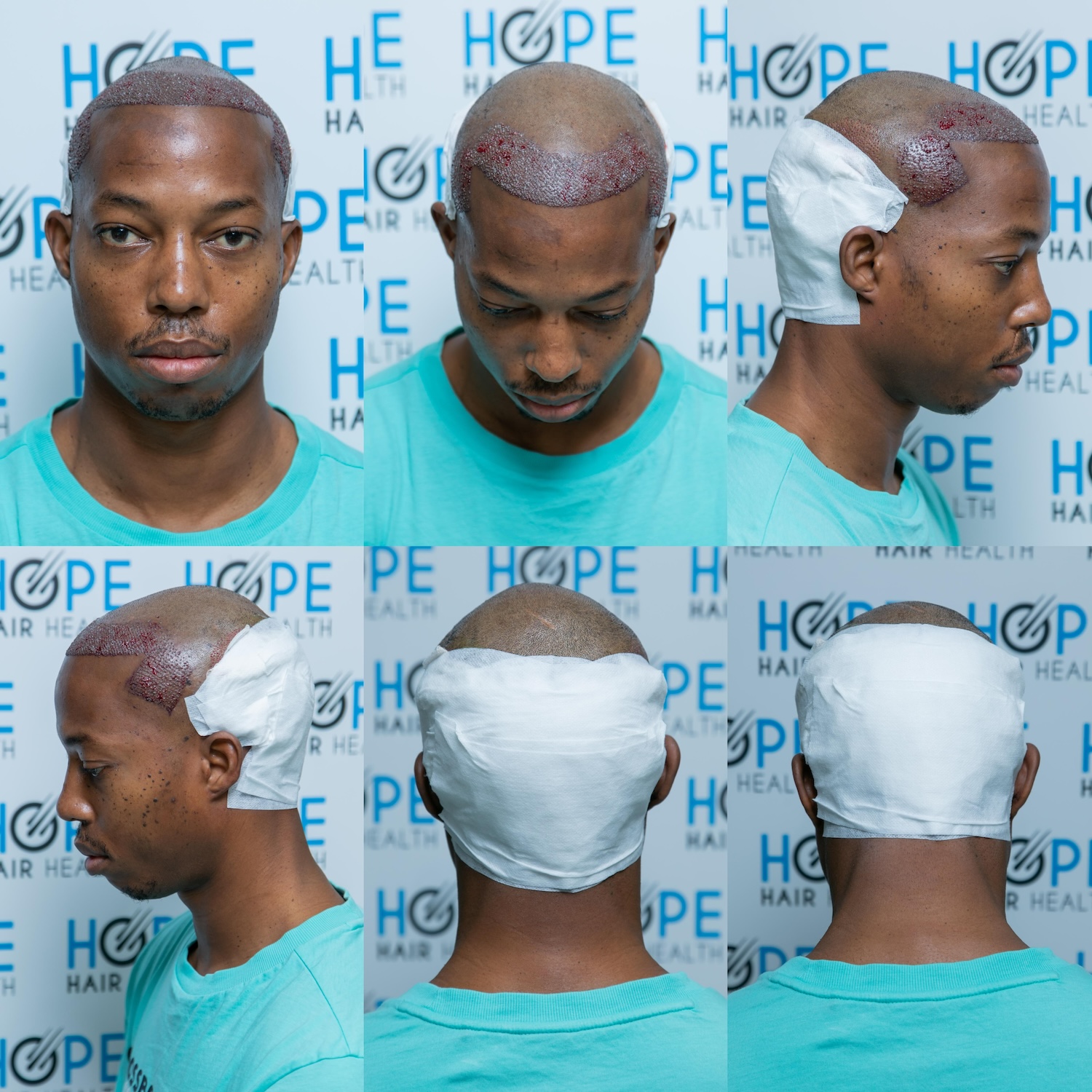 AFRO FUE — Hope Hair Health