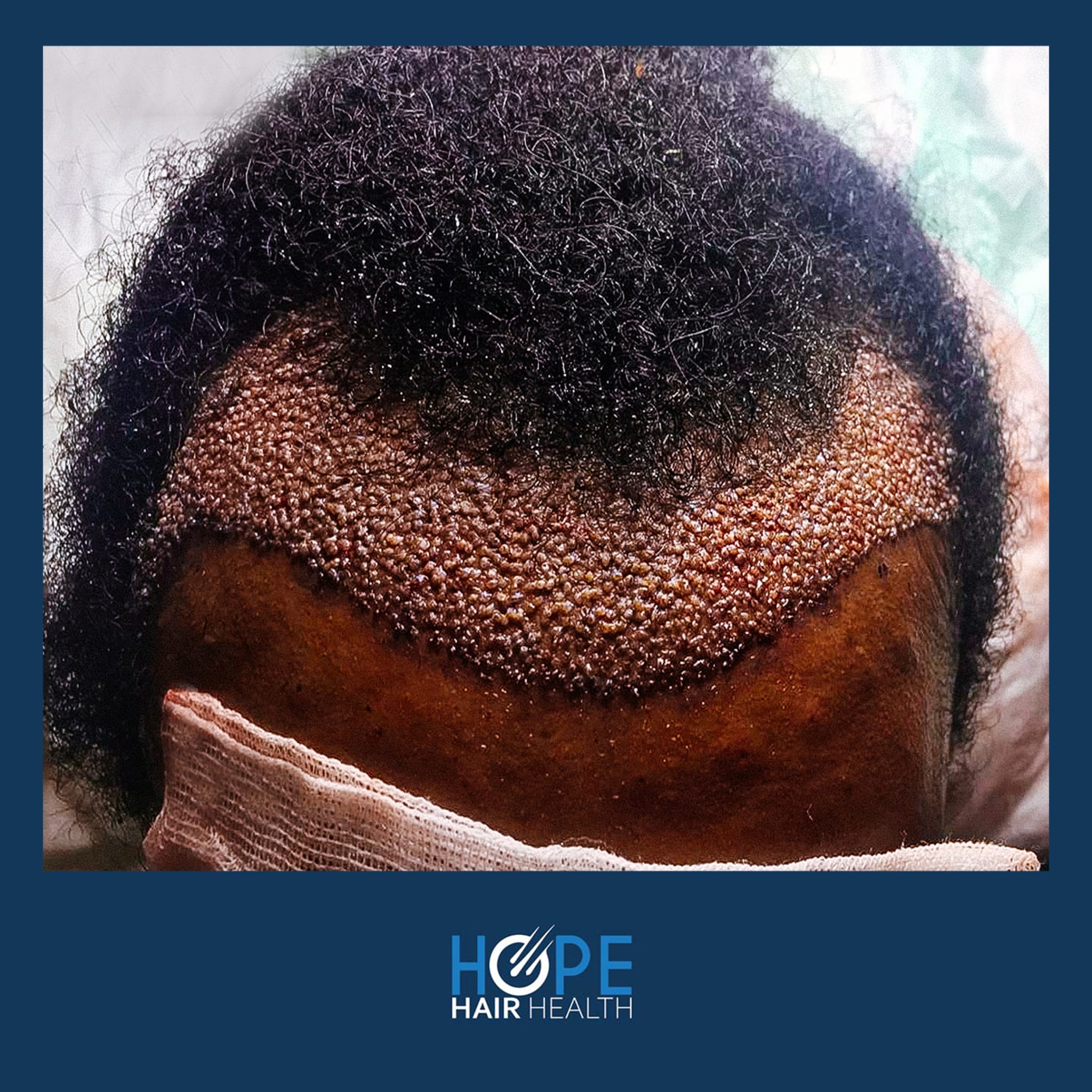 AFRO FUE — Hope Hair Health