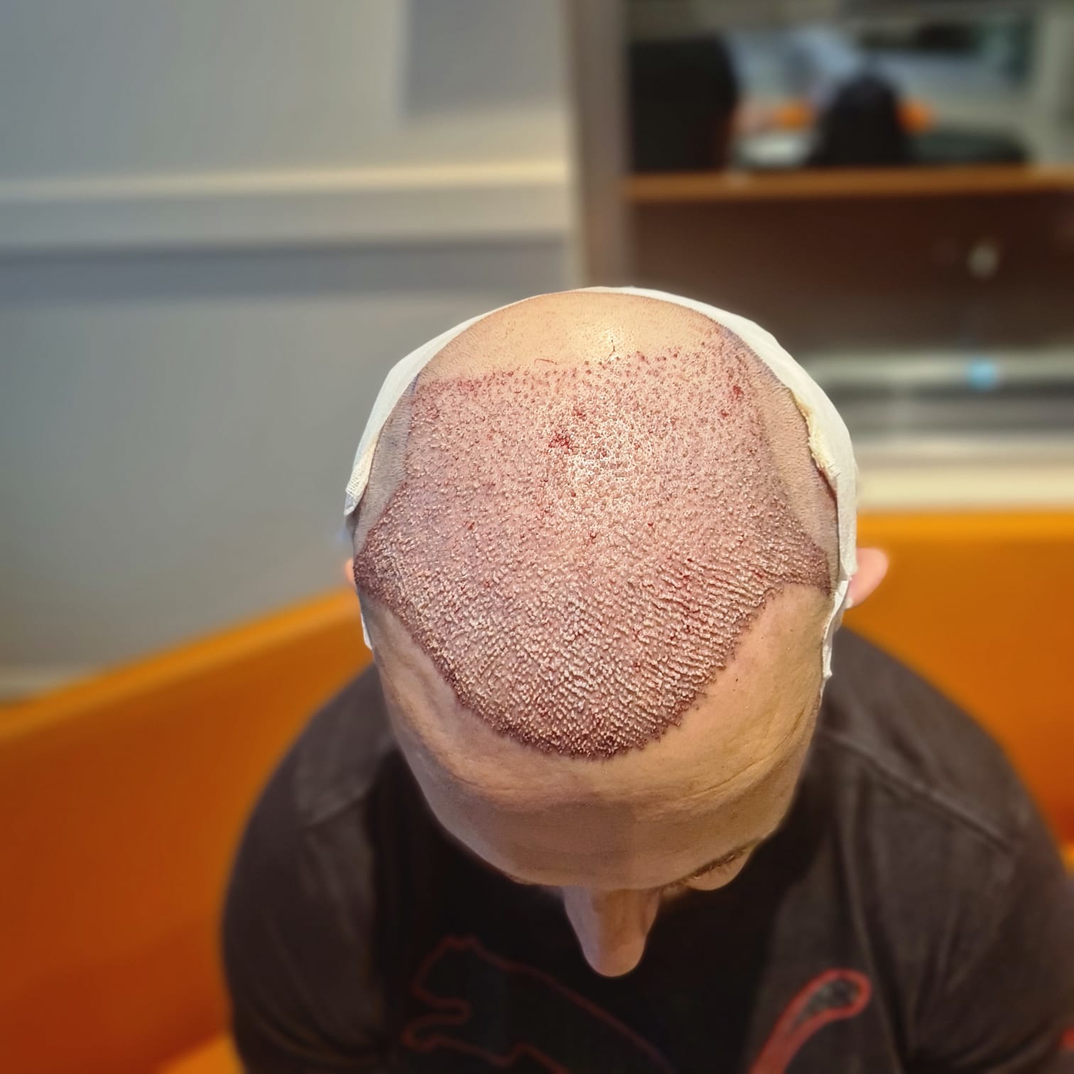 FUE — Hope Hair Health