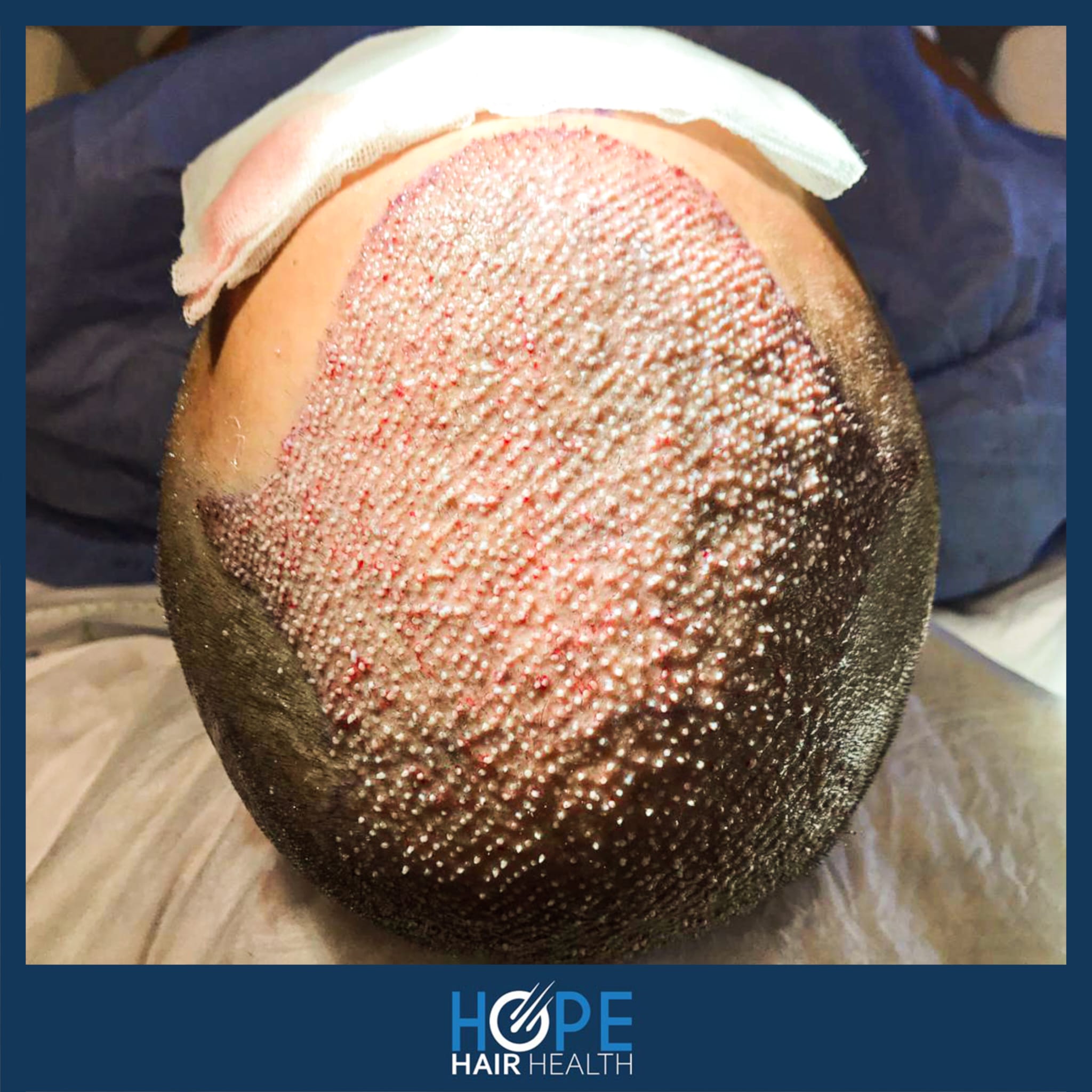 FUE — Hope Hair Health
