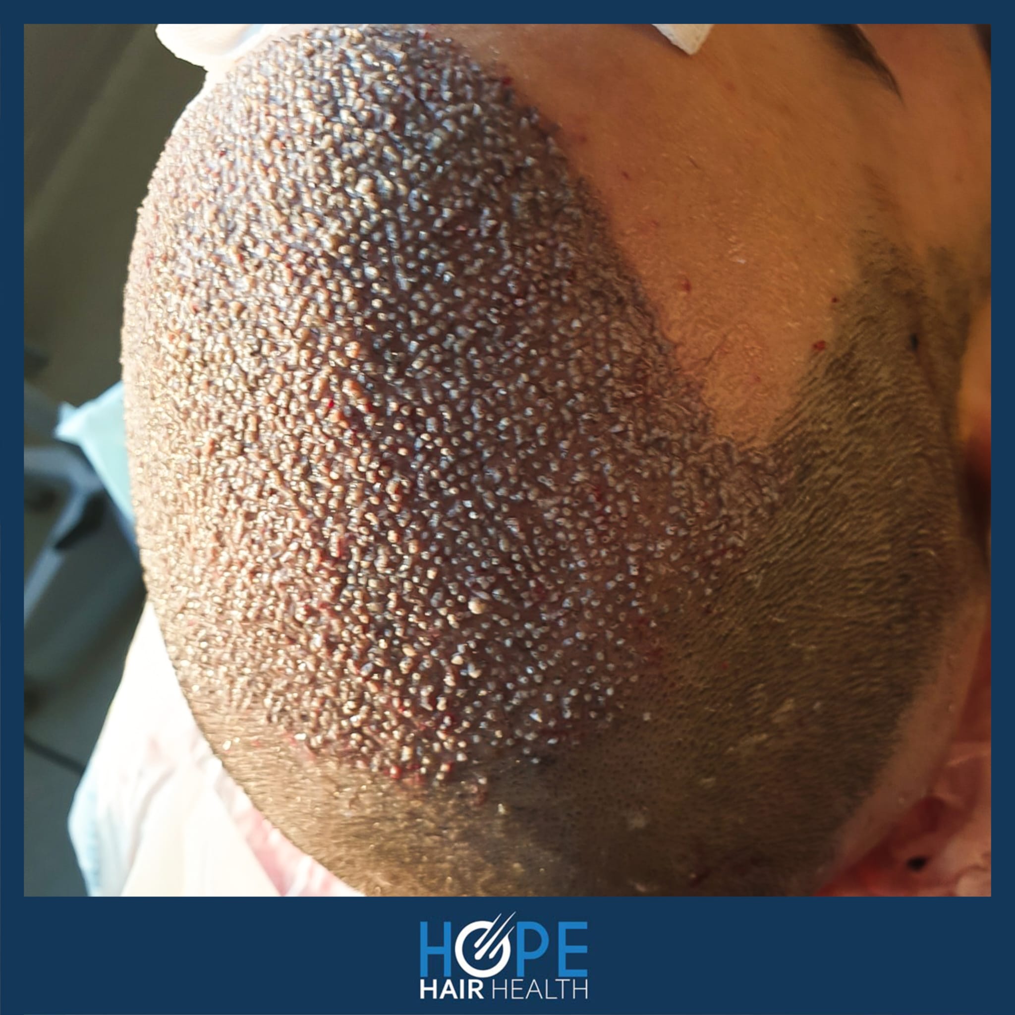 FUE — Hope Hair Health