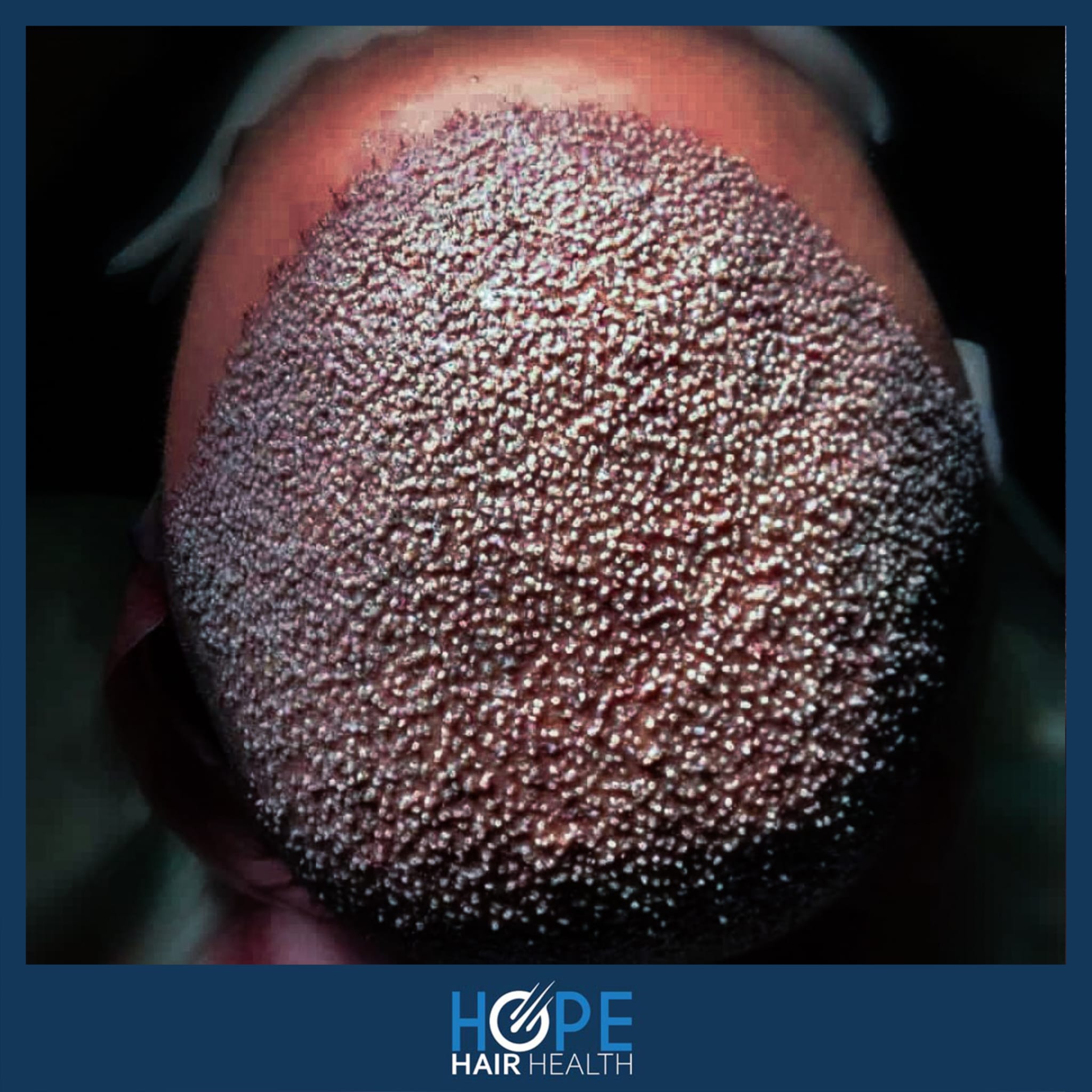 FUE — Hope Hair Health