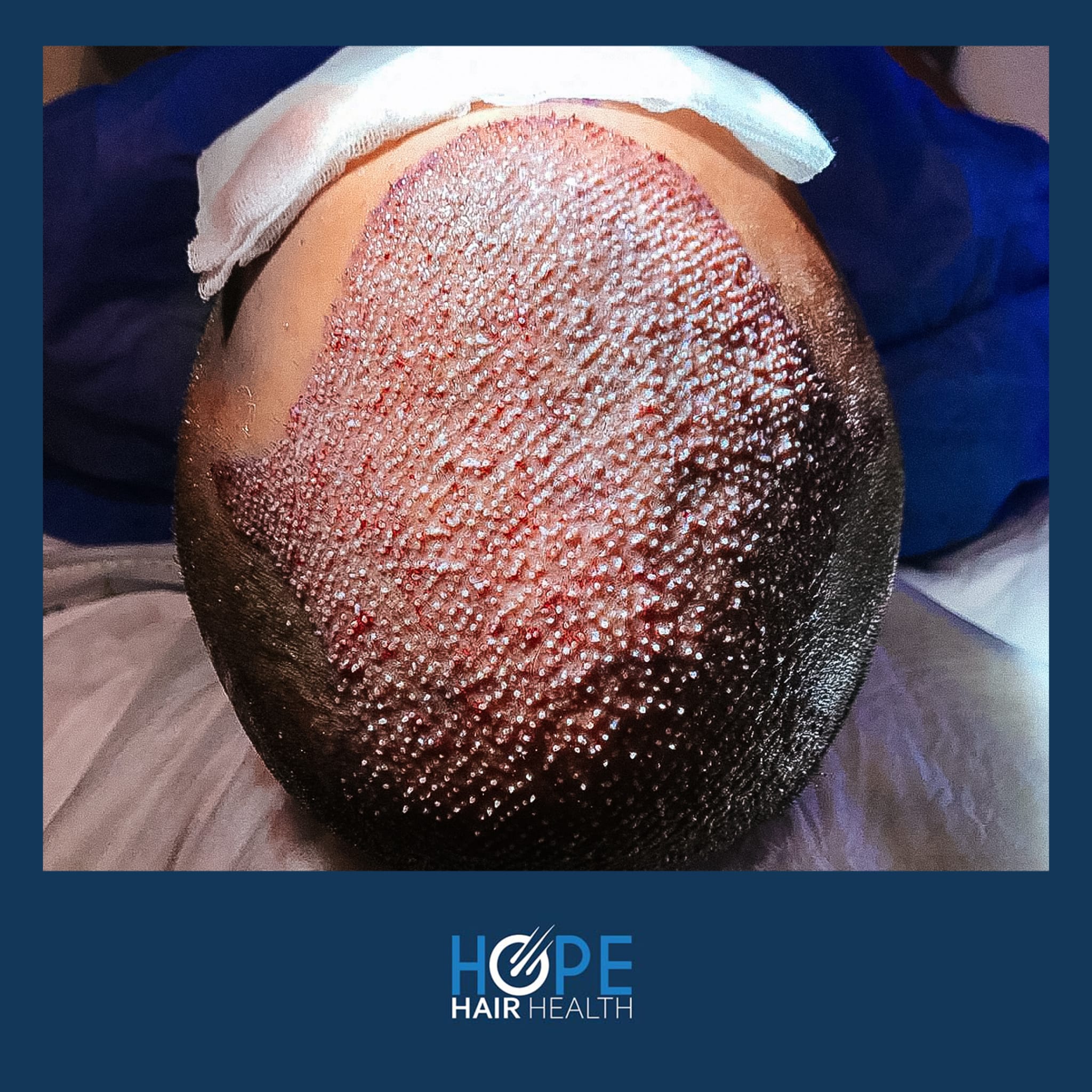 FUE — Hope Hair Health