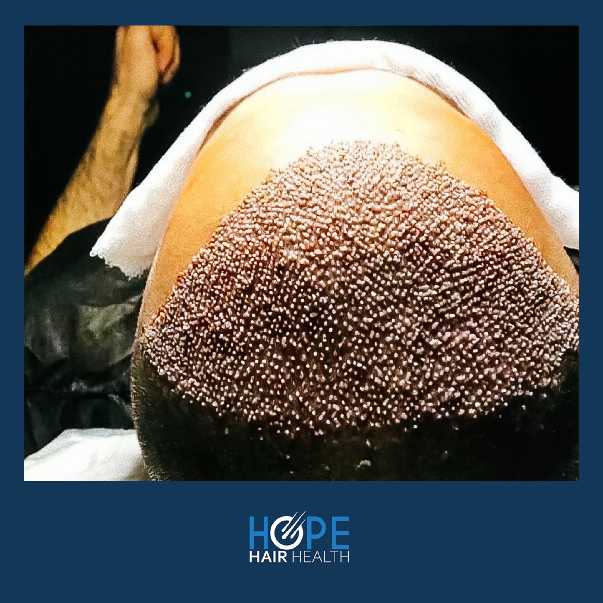 FUE — Hope Hair Health