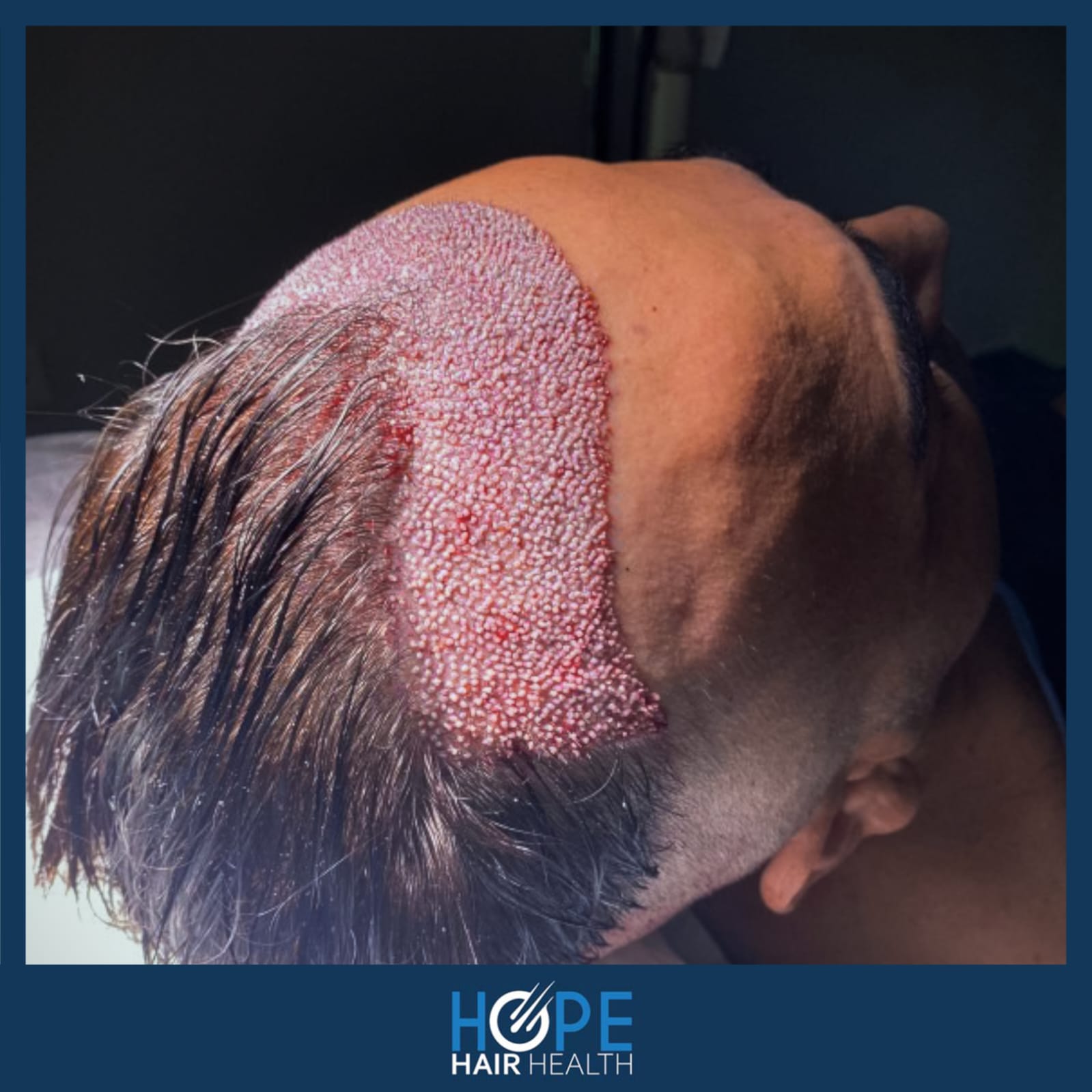 DHI — Hope Hair Health