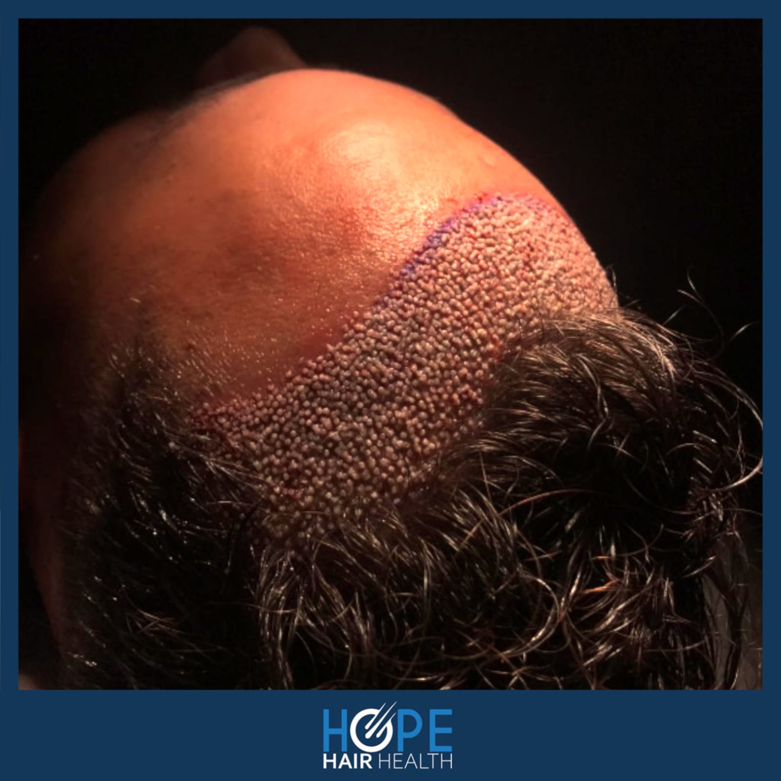 DHI — Hope Hair Health
