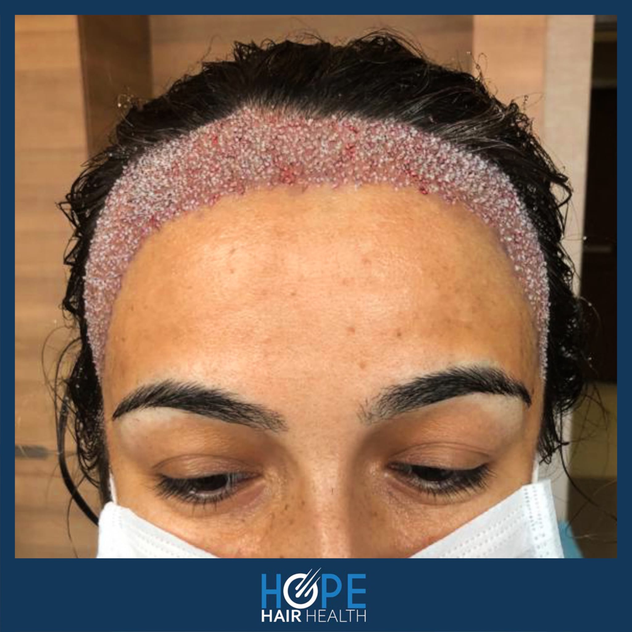 DHI — Hope Hair Health