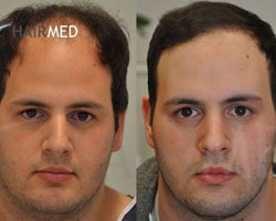 FUE — Dr. Sikos Geza Clinic