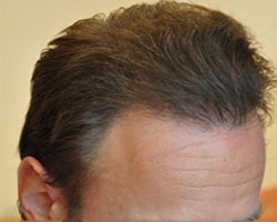 FUE — Dr. Sikos Geza Clinic