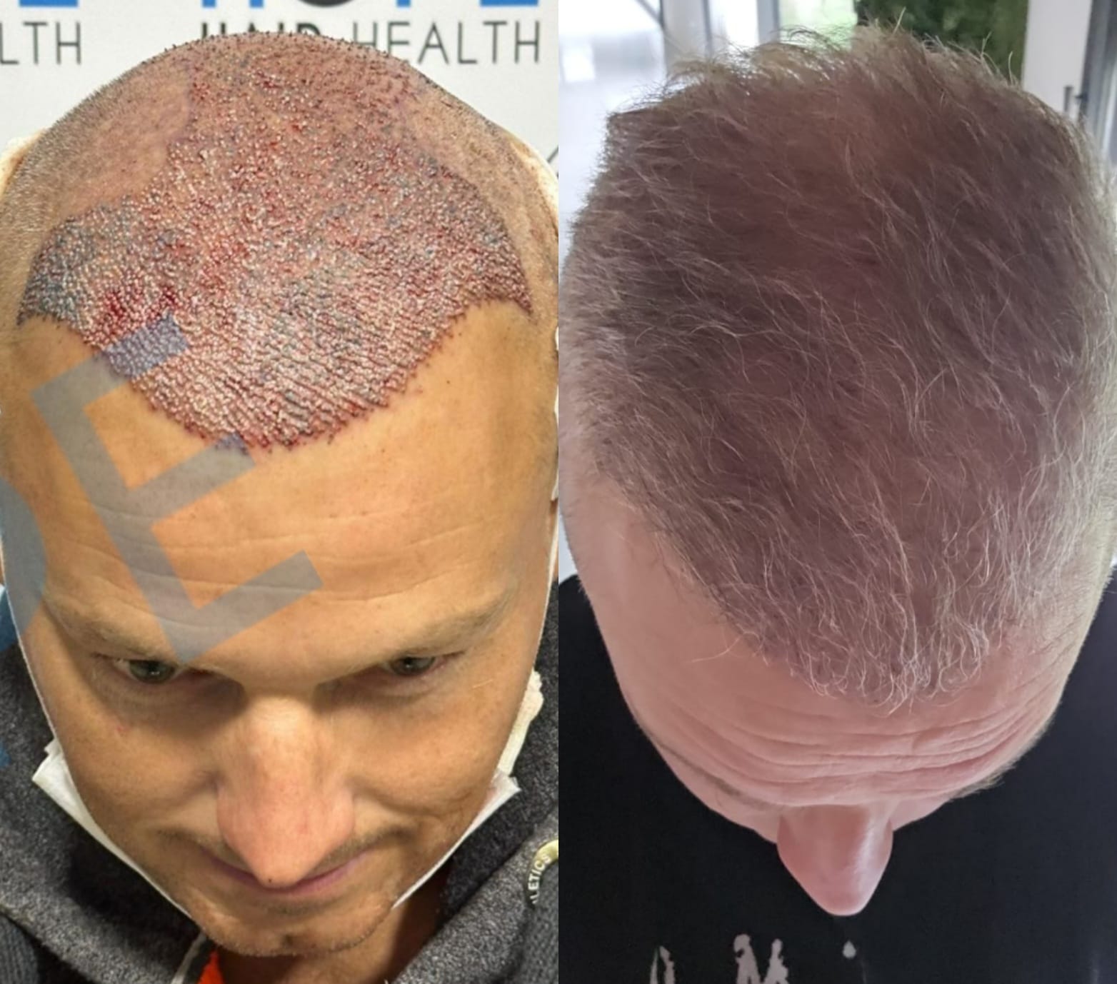 FUE — Hope Hair Health