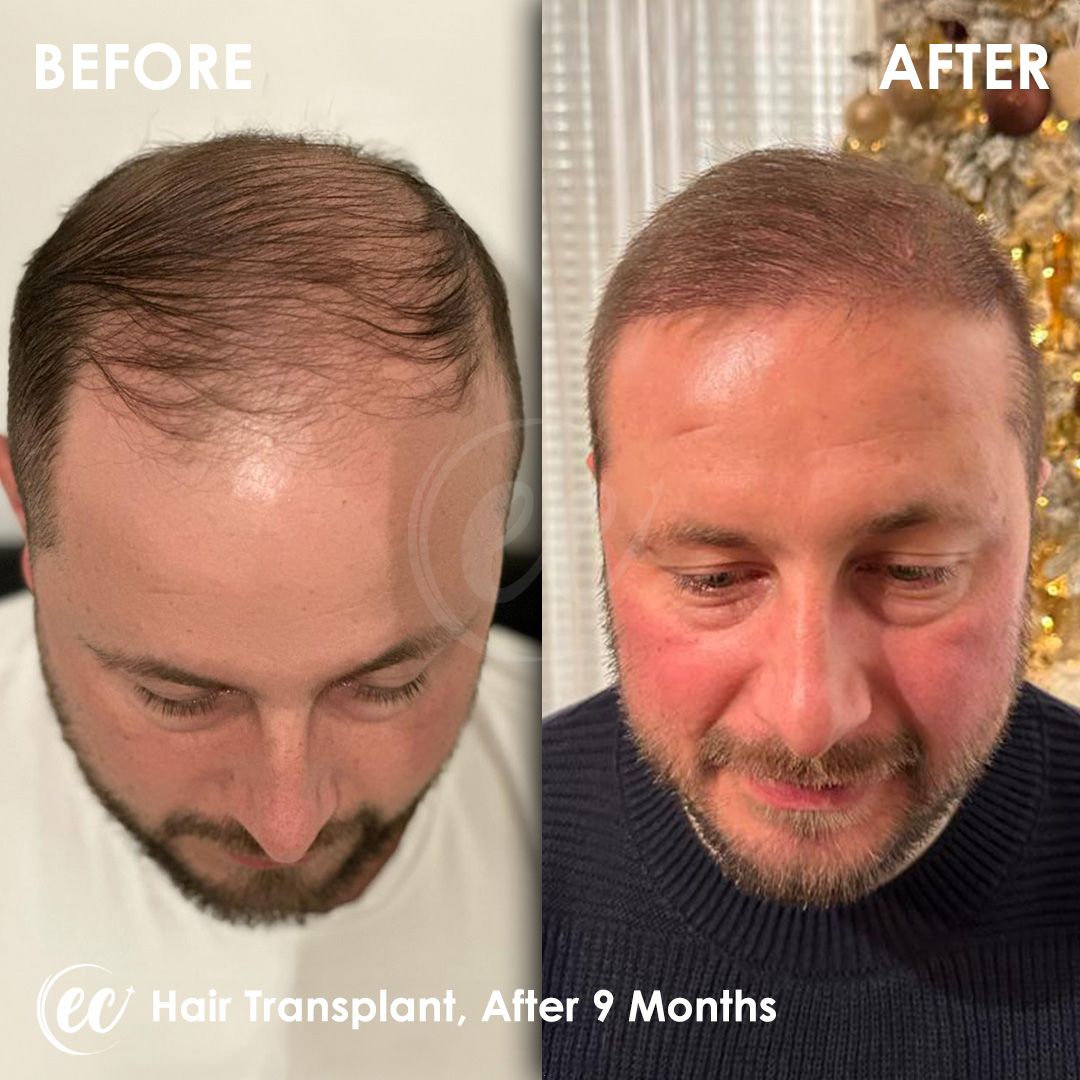 FUE — Estherian clinic