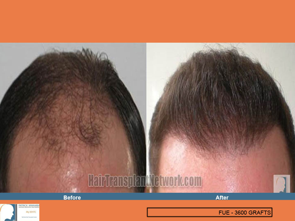FUE — Dr Patrick Mwamba