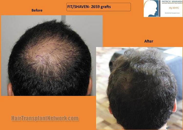 FUE — Dr Patrick Mwamba