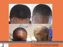 FUE — Dr Patrick Mwamba