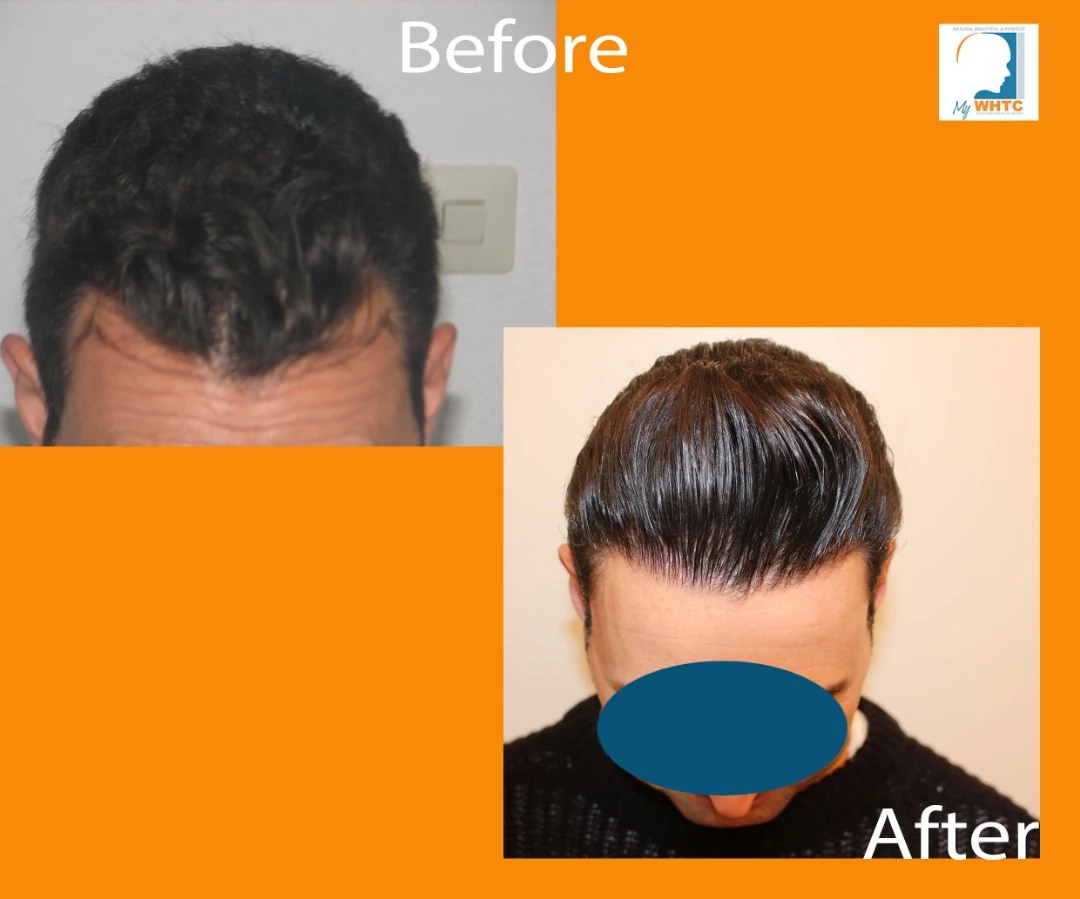 FUE — Dr Patrick Mwamba