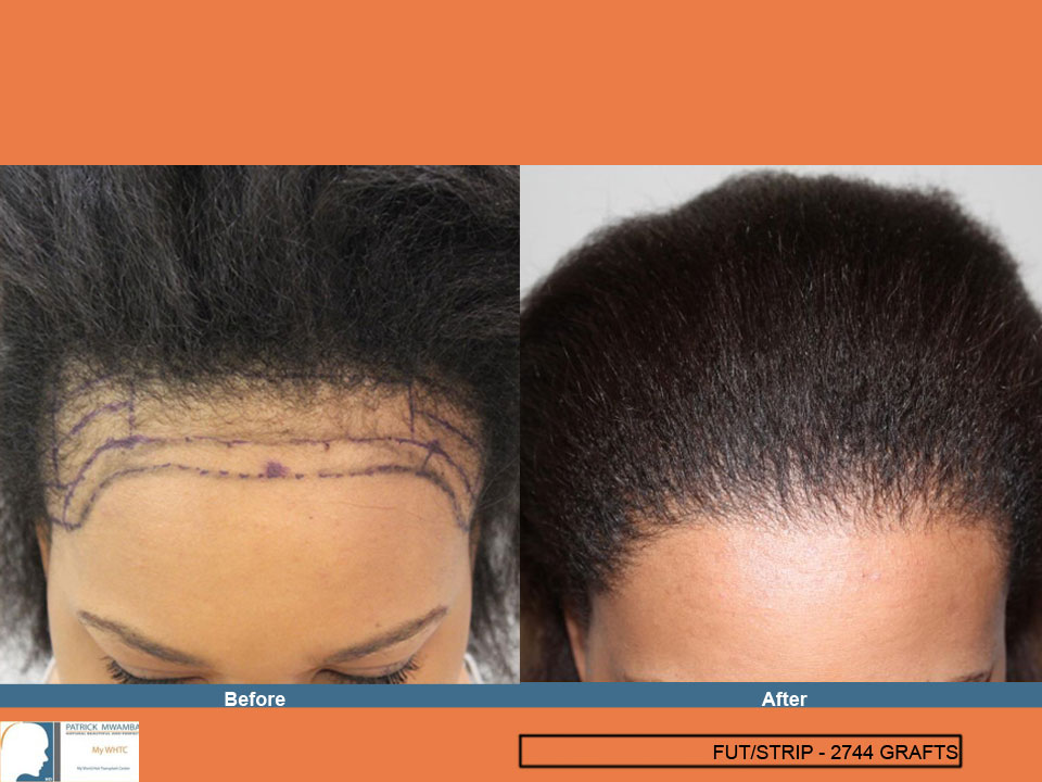 FUE — Dr Patrick Mwamba