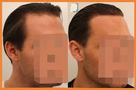 FUE — Dr Patrick Mwamba