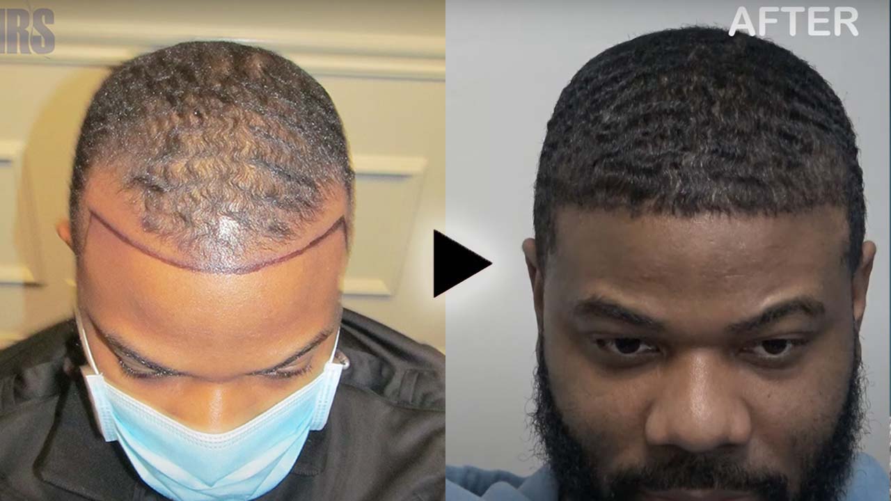 FUE — Dr Patrick Mwamba