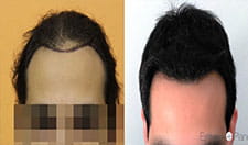 FUE — BHR Dr Bisanga