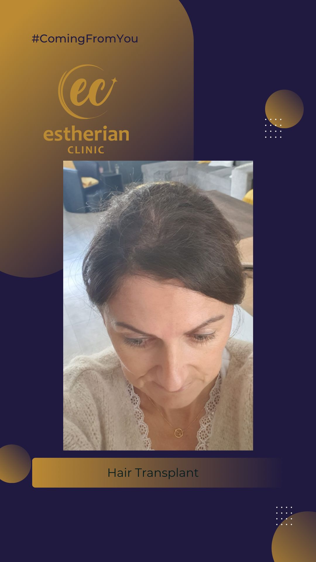 FUE — Estherian clinic