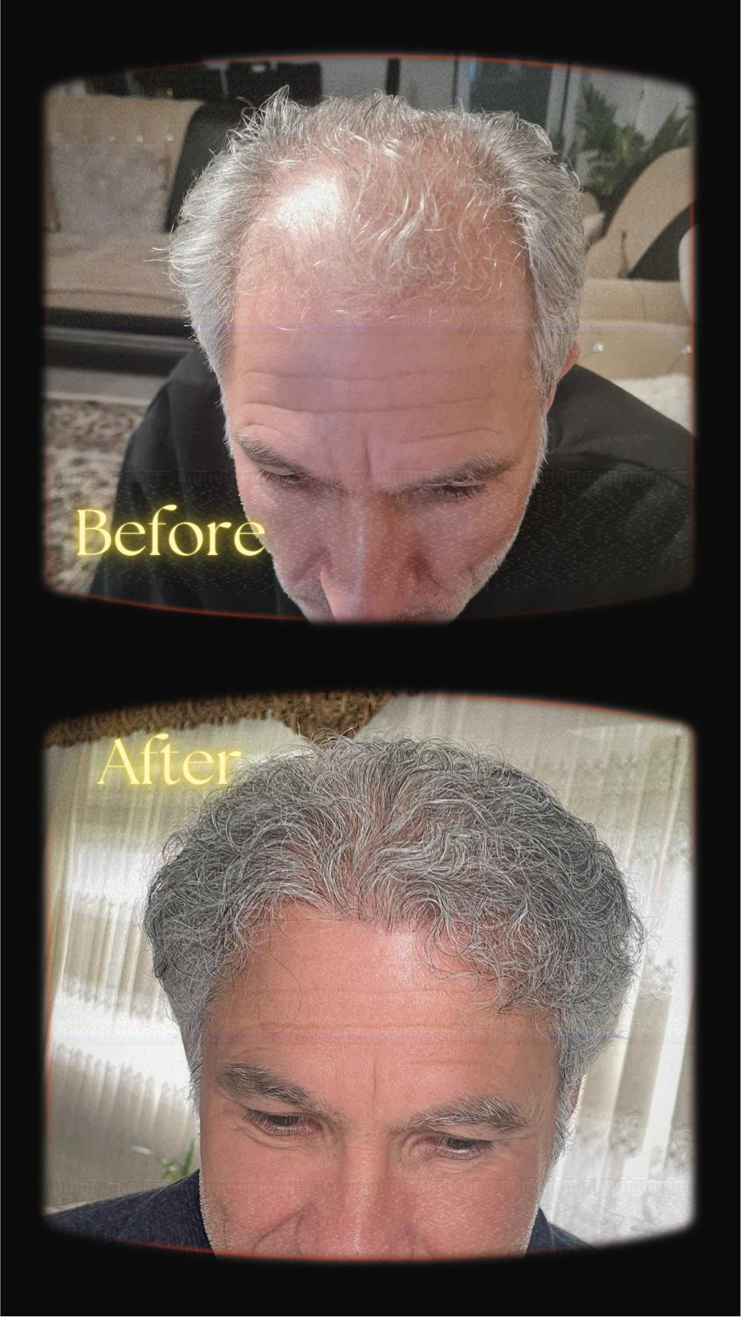 FUE — Estherian clinic