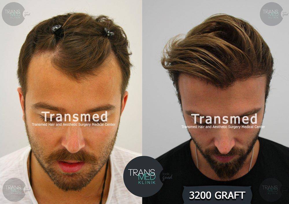 FUE — Transmed Hair Clinic