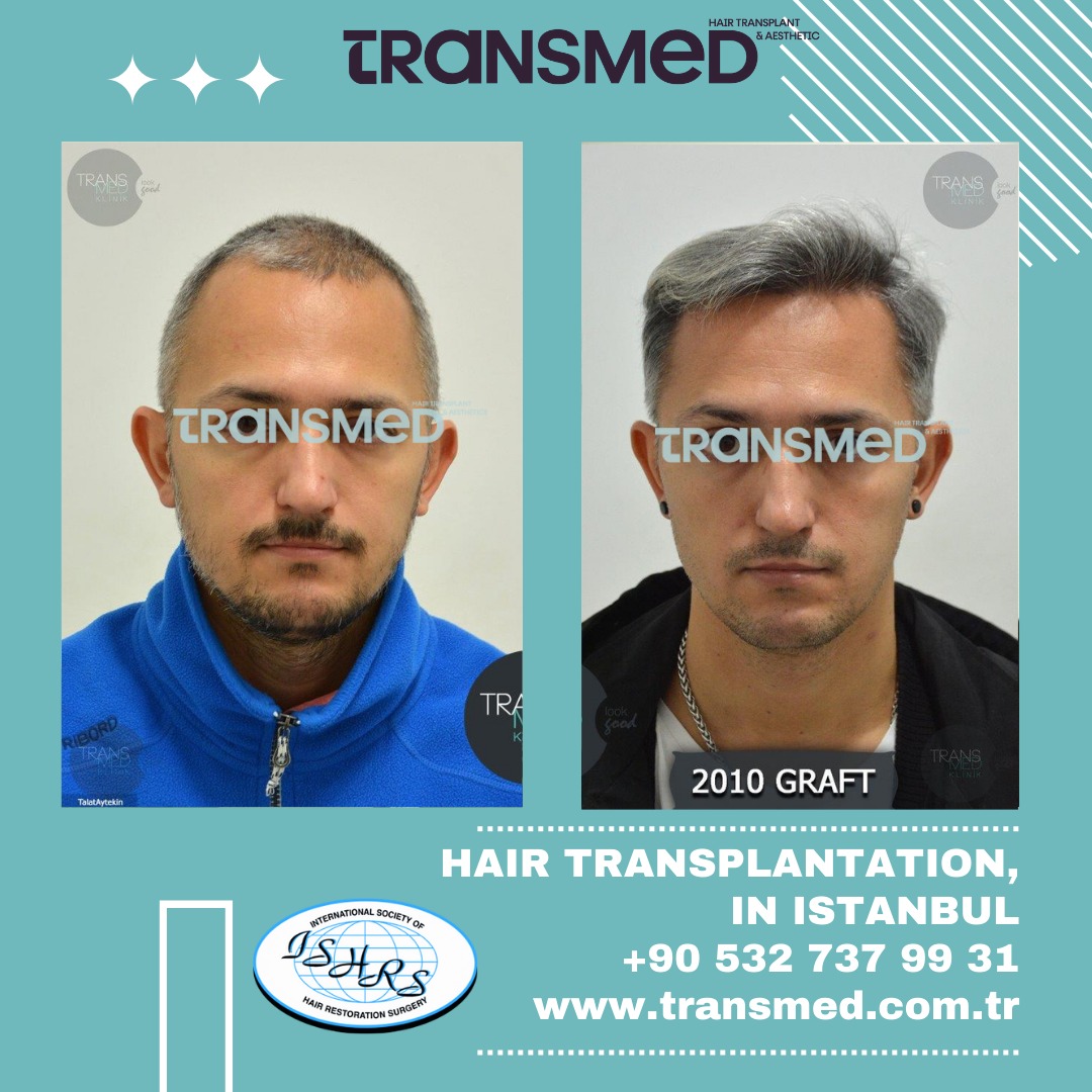 FUE — Transmed Hair Clinic
