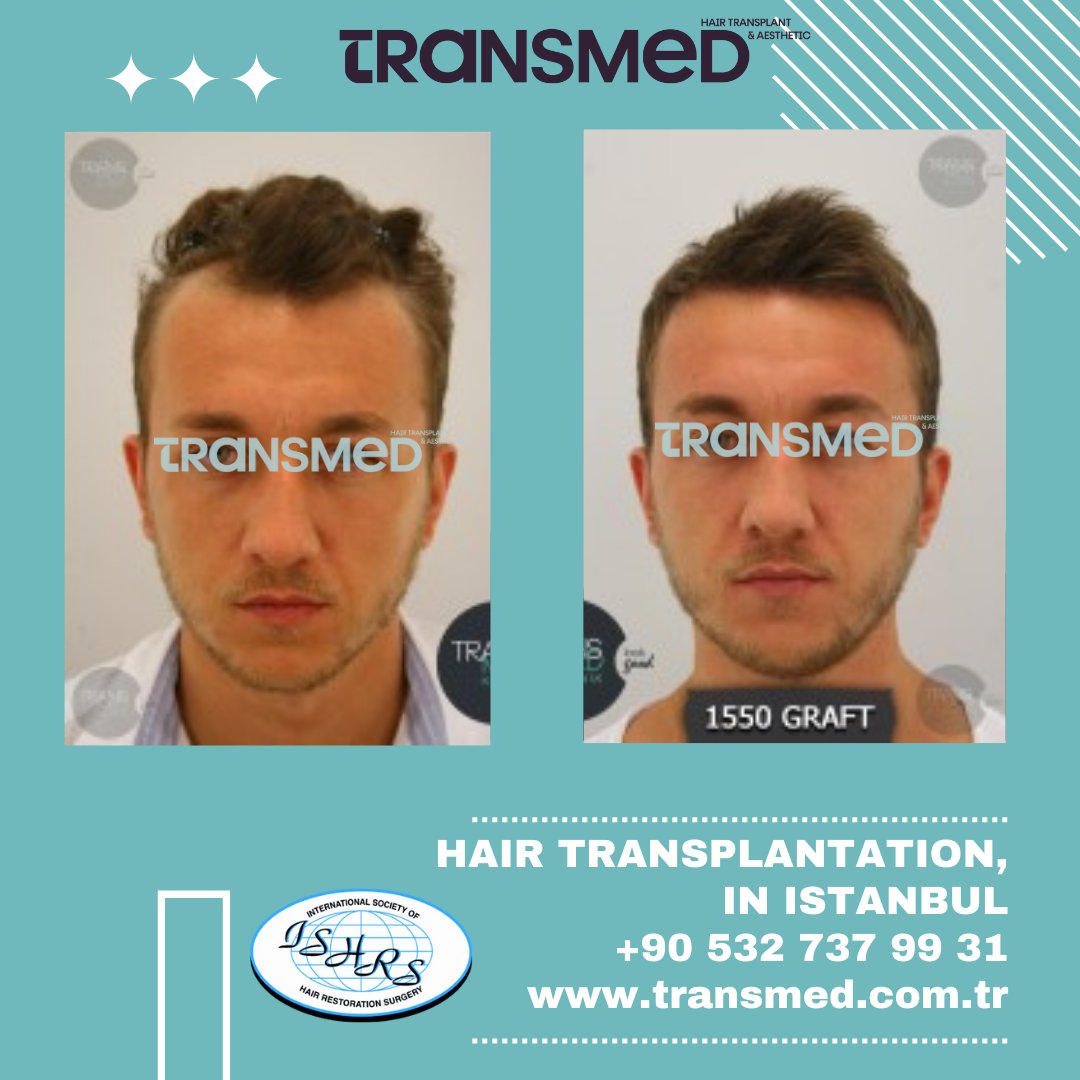 FUE — Transmed Hair Clinic