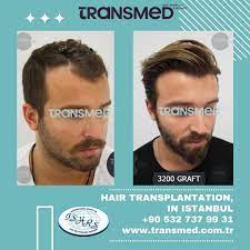 FUE — Transmed Hair Clinic