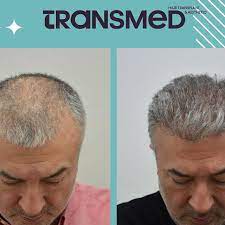 FUE — Transmed Hair Clinic