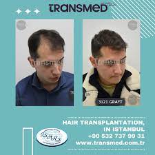 FUE — Transmed Hair Clinic
