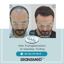 FUE — Transmed Hair Clinic