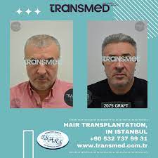 FUE — Transmed Hair Clinic