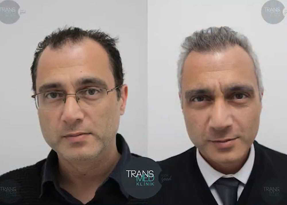 FUE — Transmed Hair Clinic